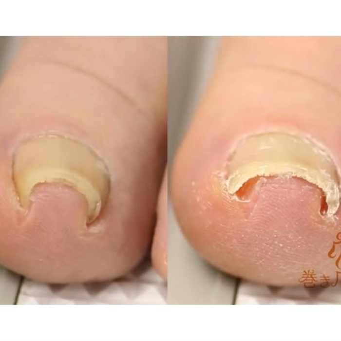 Ayak Batık Tırnak Çıkartıcı Aparat