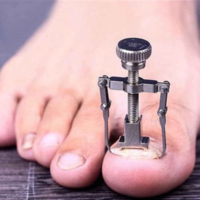 Ayak Batık Tırnak Çıkartıcı Aparat