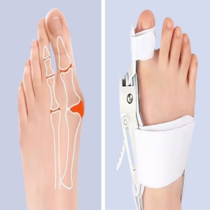 ® Yeni Ürün Ayarlanabilir Ayak Baş Parmak Kemik DüzelticiHalluks Valgus (Bunyon) Aparatı, Gece Gündüz Kullanıma Uygun Ayak Düzeltme Ateli