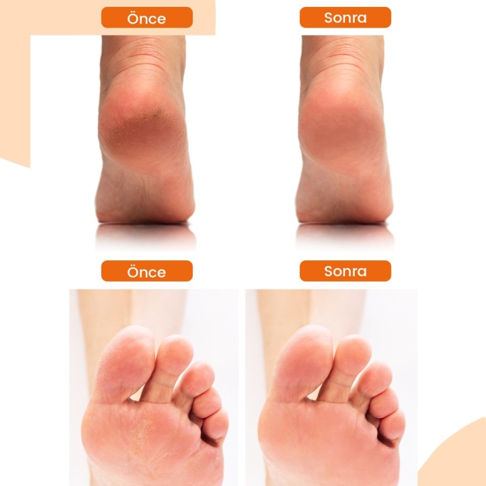 ® Yeni Ürün Topuk Çatlak ve Ayak Bakım Peeling SpreyiKoku Giderici ve Nemlendirici Foot Care Spray 250ml