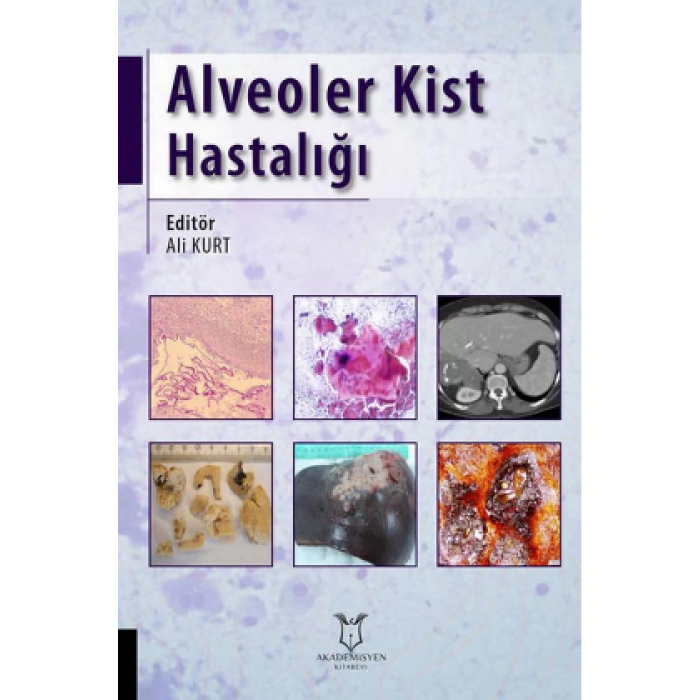 ALVEOLER KİST HASTALIĞI