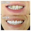 Perfect Smile Tak Kullan Takma Beyaz Diş