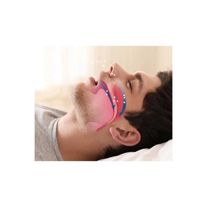 Rahat Uyku İçin Anti Snore Sleep Horlama Engelleyici Aparat