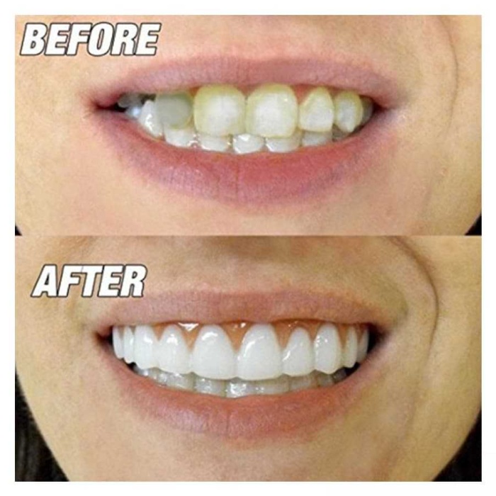 Perfect Smile Tak Kullan Takma Beyaz Diş